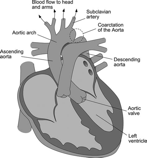 Coarctation Of The Aorta Circulation