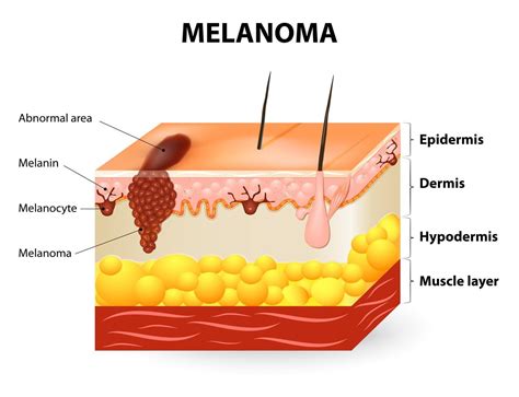 7 Skin Cancer Warning Signs You Should Never Ignore The Polka Dot Daisy