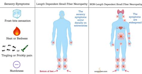 Small fiber neuropathy causes and treatment – Artofit