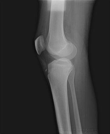 Avulsion Fractures Of The Knee Radiology Reference Article