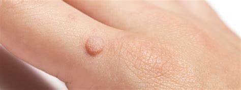 4 Common Warts And How Theyre Treated Dallas Derm Center