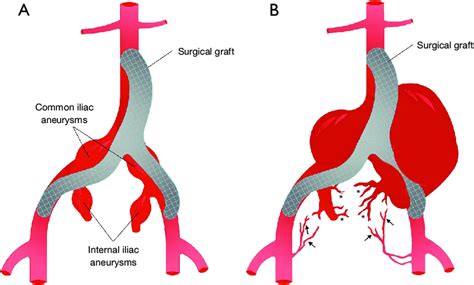 Vascular Illustration A Aorto Bifemoral Repair With Bifurcated