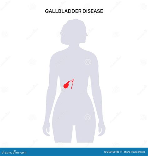 Gallbladder Diseases Poster Vector Illustration | CartoonDealer.com