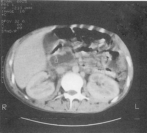 Abdominal CT scan showing pancreatic pseudocyst | Download Scientific Diagram