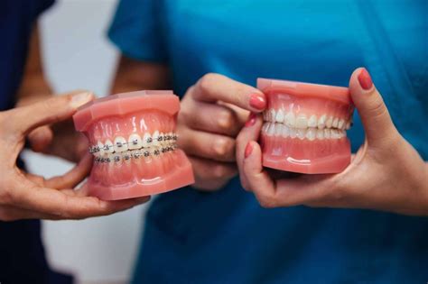 5 Ventajas De La Ortodoncia Invisible Invisalign Frente A Los Brackets