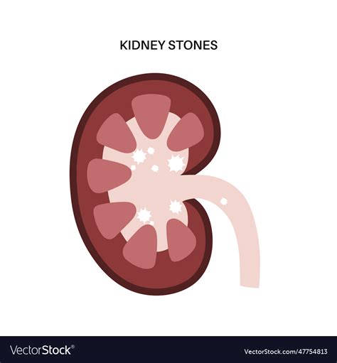 Kidney Stones Treatment Royalty Free Vector Image