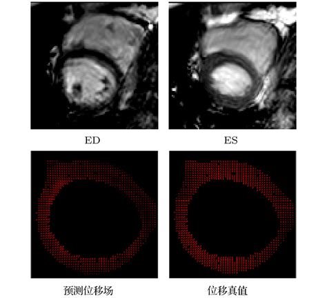 Motion Tracking Of Left Myocardium In Cardiac Cine Magnetic Resonance