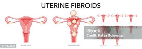 Ilustración De Conjunto De Fibromas Uterinos Leiomiomas Femeninos Del Sistema Reproductor Útero