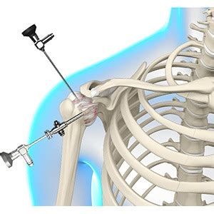 Arthroscopic Frozen Shoulder Release Daniel C Acevedo M D