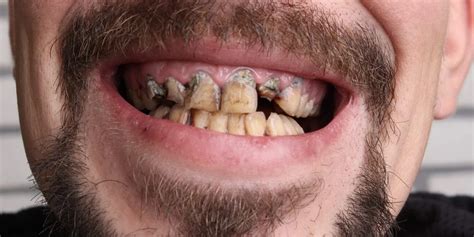 Can Teeth Scaling And Polishing Remove Cigarette Smoking Stains