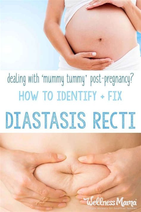 How To Identify And Fix Diastasis Recti Wellness Mama Diastasis