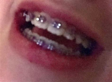 Braces Teeth Colors Cute Braces Colors Teeth Braces Dental Braces