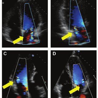 Echocardiograms Baseline A And B Demonstrates Apical Displacement