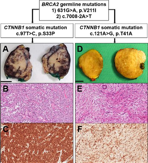 Figure 1 From Solid Pseudopapillary Neoplasm Of The Pancreas And