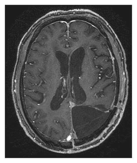 Example Of Nsvze A Year Old Male With Pathologically Confirmed