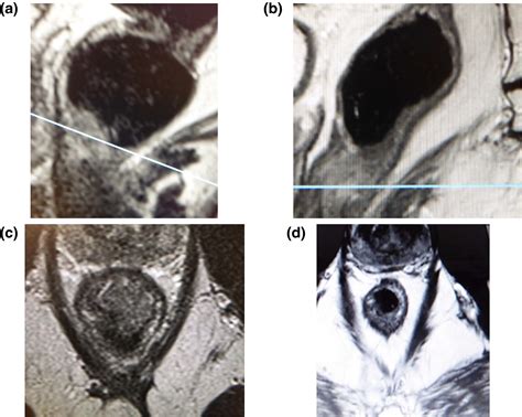 Treatment The Role Of Contact X‐ray Brachytherapy Papillon In The