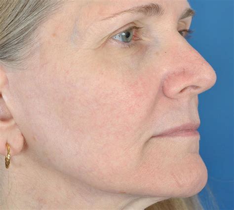 Dermav Laser Before And After Patient 01 Houston