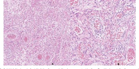 Figure 2 From Cellular Angiofibroma A Rare Vulvar Tumor Case Report