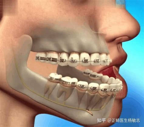 孩子前面牙地包天，几岁矫正好？戴什么牙套？ 知乎