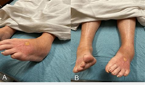 Lower Extremity Physical Findings Showing Left Ankle Swelling And A Download Scientific Diagram