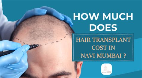 Details 159 Female Hair Transplant In Mumbai Best Vn