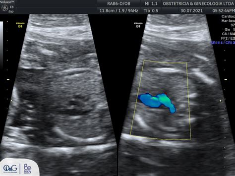 Ecocardiografía Fetal