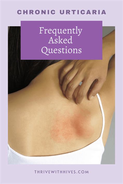 Chronic Urticaria Hives Faqs And Resources Thrive With Hives