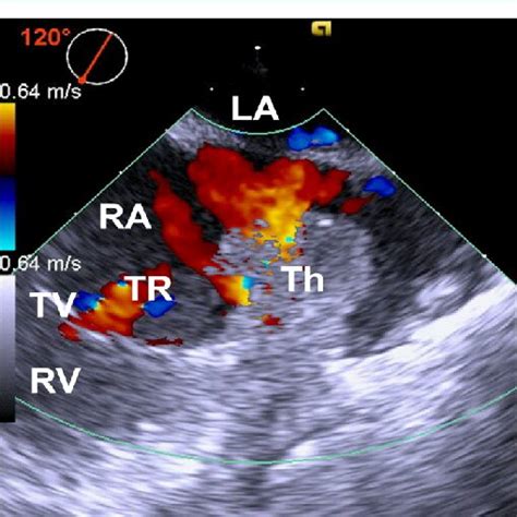 Midesophageal Modified Bicaval View Of Transesophageal Echocardiography