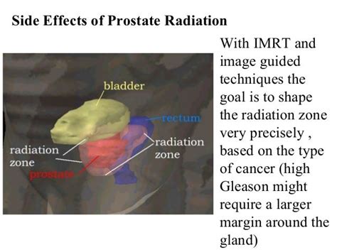 side effects of radiotherapy - DriverLayer Search Engine