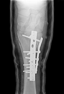 Fracture of the proximal metacarpus – Clinica Equina Bagnarola