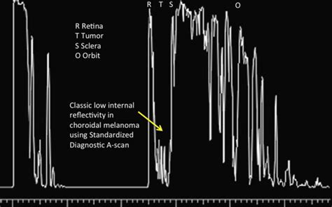 Diagnostic Ophthalmic Ultrasound For Radiologists Radiology Key