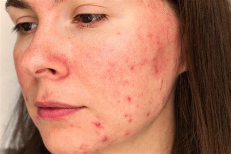 Rosacea Ursachen Symptome Behandlung Sanubiom