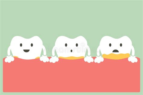 Periodontal Disease With Plaque Or Tartar Stock Vector Illustration