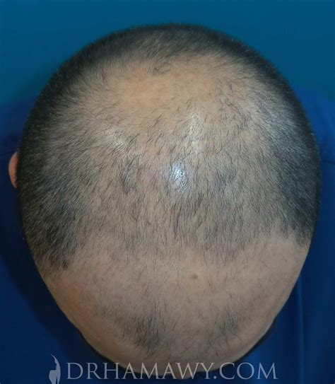 Hair Transplant Before After 11 Hair Transplant Hair Restoration Hot