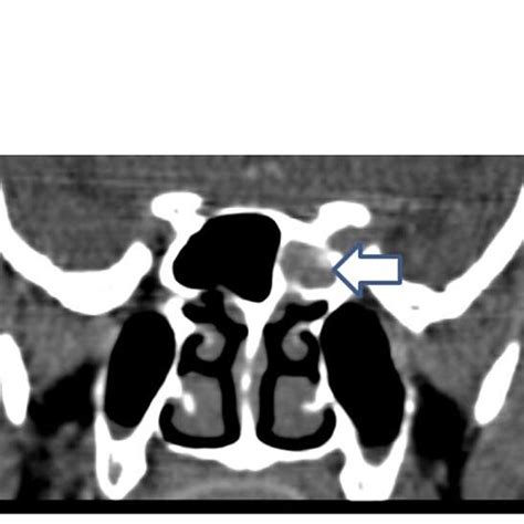 A Axial Slice Ct Paranasal Sinus At The Level Of Sphenoid Sinus With Download Scientific