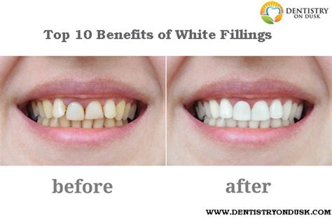 Cavity Filling Before And After