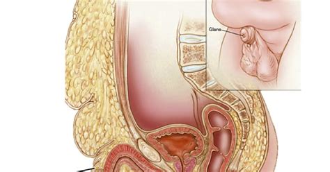 Falando sobre Pênis O que é um pênis escondido ou embutido