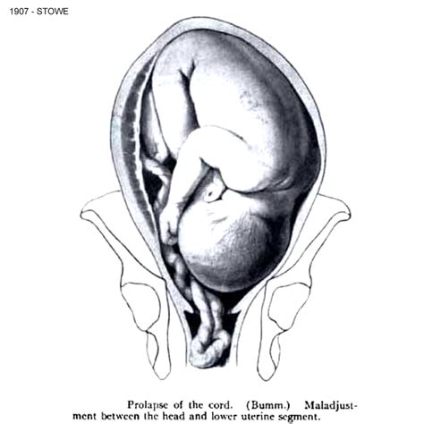 Umbilical Cord History Of Midwifery Obstetrics Gynecology