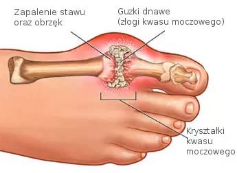 Dna Moczanowa Przyczyny Choroby I Metody Leczenia