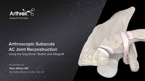 Arthrex Arthroscopic Subacute Ac Joint Reconstruction Using The Dog