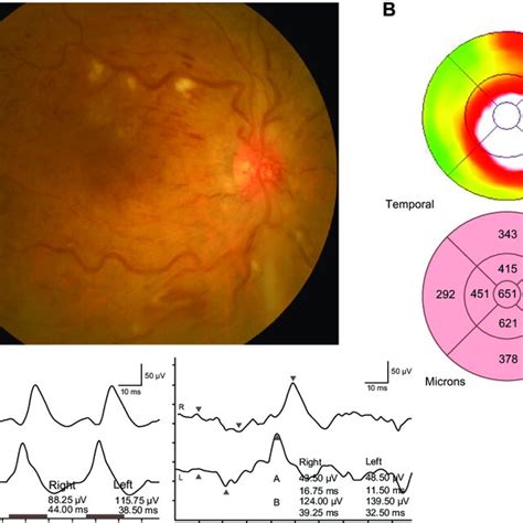 Representative Fundus Color Photograph Measurement Of Retinal Download Scientific Diagram