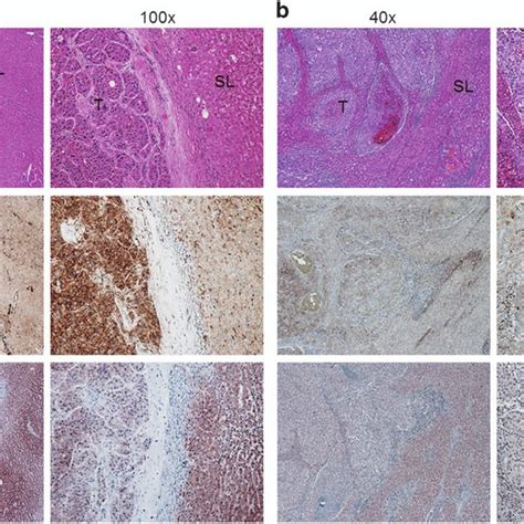 Expression Patterns Of C Met And Pten In Human Hepatocellular Carcinoma