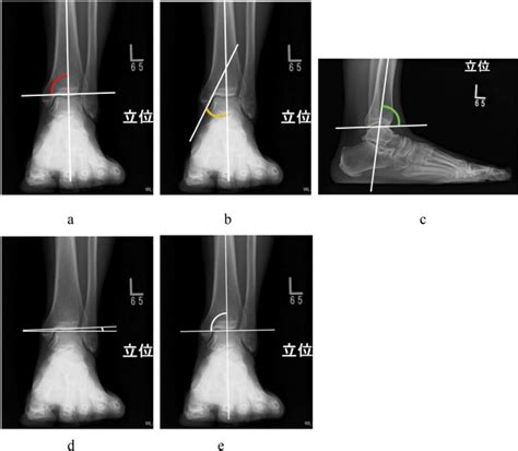 Distal Tibial Oblique Osteotomy For Reconstruction Of Ankle Joint