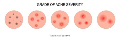 Grade Acne Severity Medical Diagram Different Stock Vector Royalty