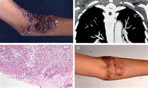 Takayasu Arteritis Histology