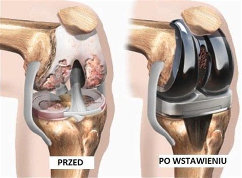 Pacjentka Po Endoprotezie Stawu Kolanowego Sport Plus Zdrowie