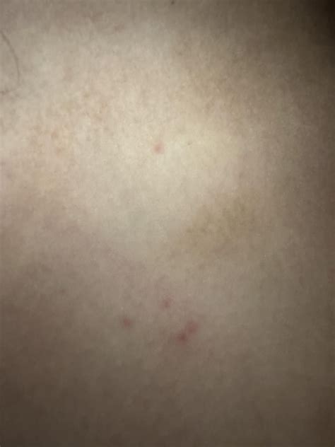 Bumps On My Chest And Stomach R Dermatologyquestions