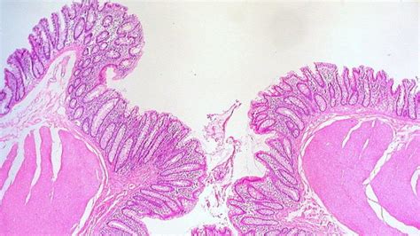 ¿qué Es La Diverticulosis Estas Son Sus Causas Sus Síntomas Y Su