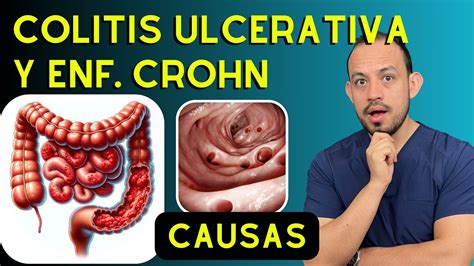 Causas De La Enfermedad De Crohn Y La Colitis Ulcerativa Cr Nica