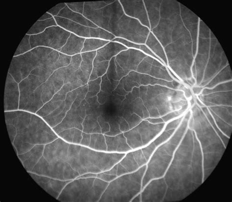 Fluorescein Angiography Test Hawaii | Fluorescein Angiography Test Honolulu